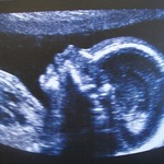 My baby girl, 19wks 4days - Morphology scan perfect!
