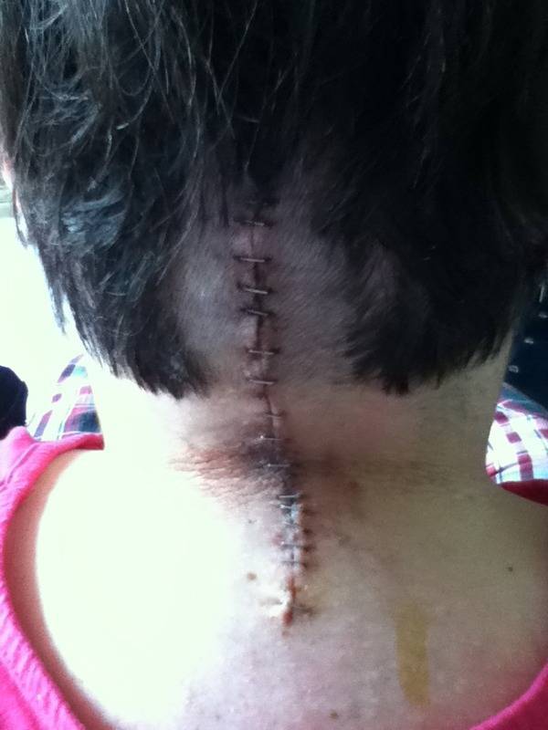Bandage Removed/Discharged 8/19/11
