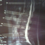 Mri lumbar spine early 2010