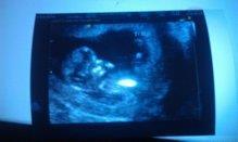 Baby 12 week ultrasound