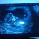 Baby 12 week ultrasound