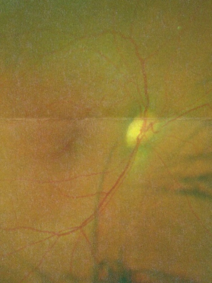 My Right Eye Optic Nerve Disc