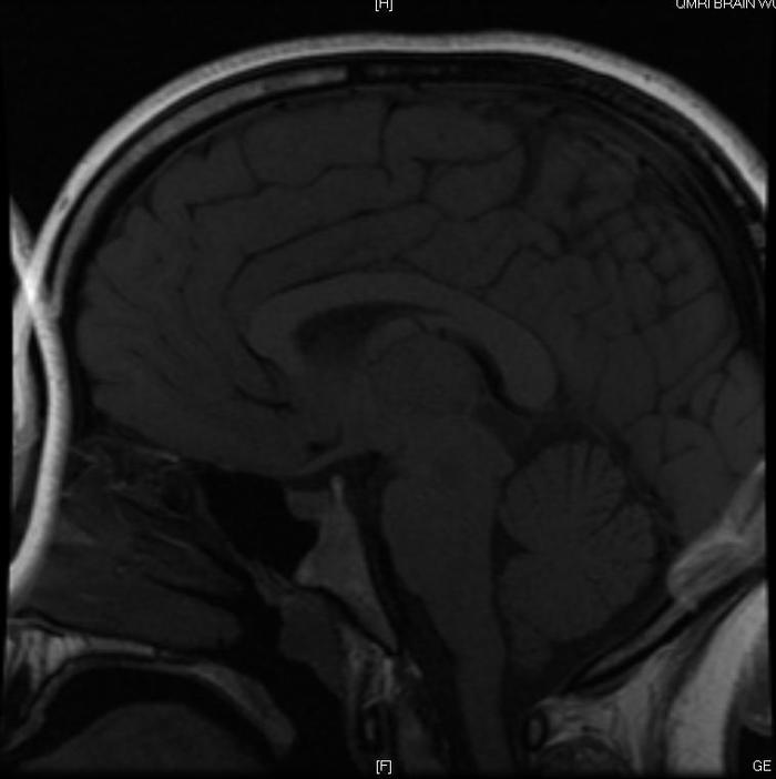 Another SAG T1 image. Look carefully at the pituitary and pineal cyst...