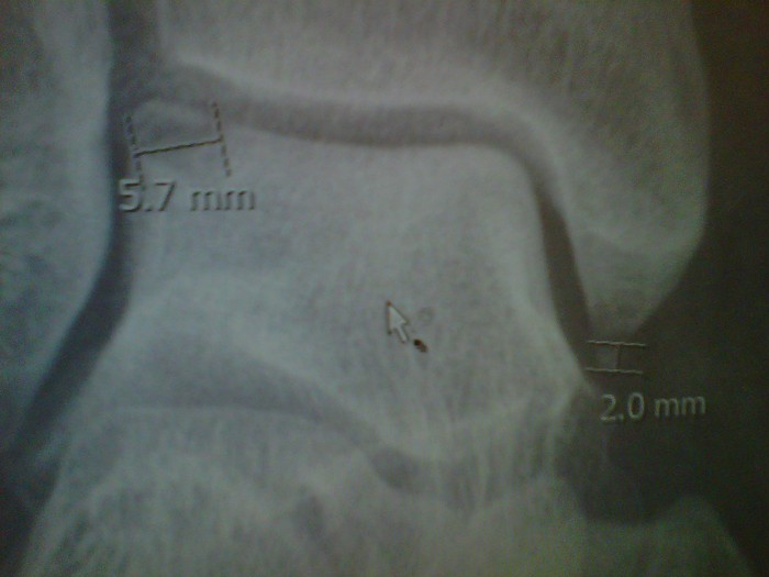 4 1/2 months after my fall xray