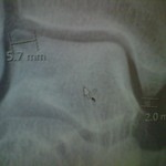 4 1/2 months after my fall xray