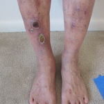 03/20/2012 Week 24  Stasis Dermatitis