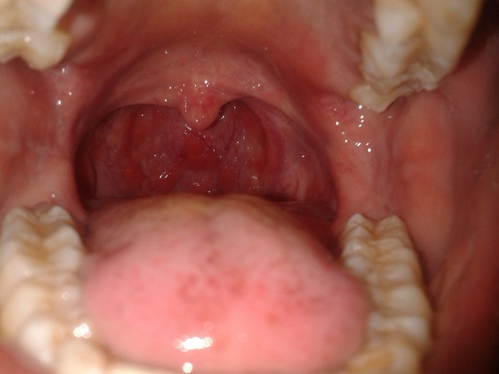 Myt  Sore Throat (Pharyngitis)