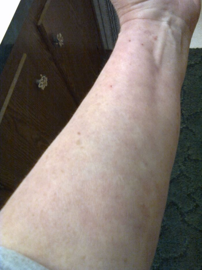 Left Arm rash mostly cleared. Week 24.  11-29-12