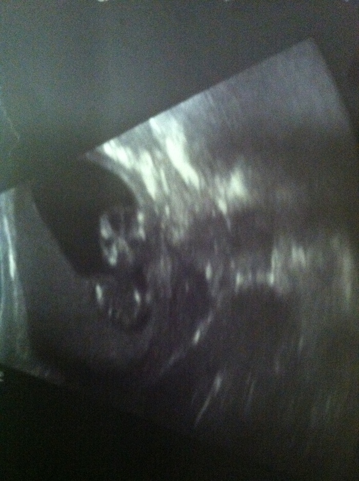 12 week scan....baby's face pic