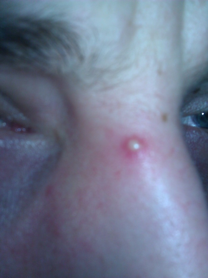 pimple or herpe?
