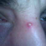 pimple or herpe?