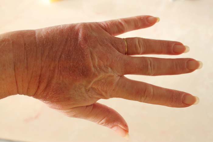 Swelling Red Rash on Hands