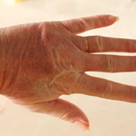 Swelling Red Rash on Hands