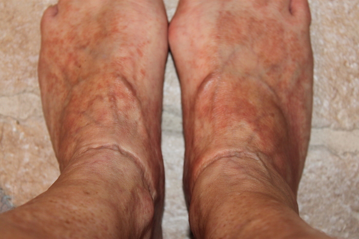 Rash & Swelling of feet