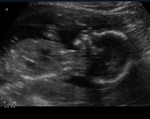 baby A: 17 weeks