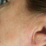 Swelling & skin peepling of face & ear