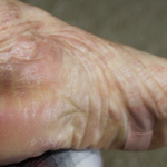 Swelling, Rash & Skin Cracking on Feet