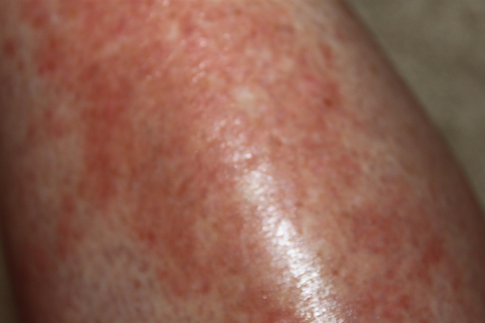 Rash reappears after therapy stopped...