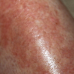 Rash reappears after therapy stopped...