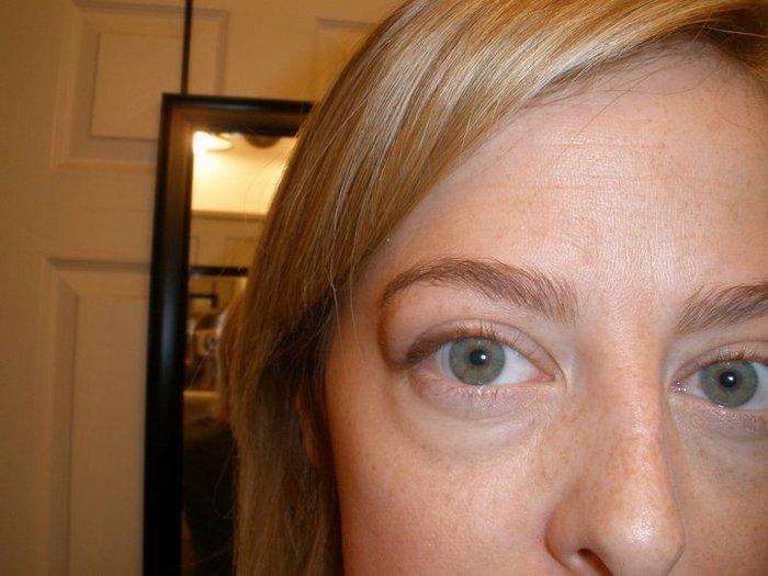 Swelling aound eyes before starting Cytomel.  2011