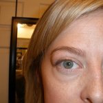 Swelling aound eyes before starting Cytomel.  2011