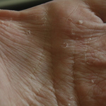 peeling skin hands' palm