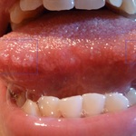 Tongue: Swollen tastebuds. December 2012