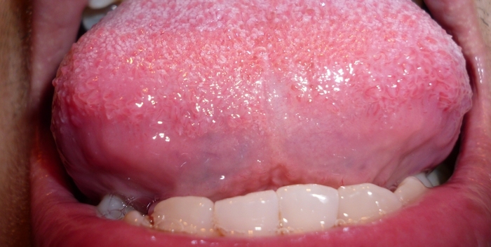 Swollen tastebuds in tongue. December 2012