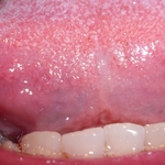 Swollen tastebuds in tongue. December 2012