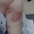 bruises I think resemble a tick bite