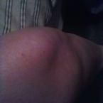 how my knee was not even a month ago and its worse now