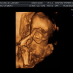 20 wk 3d ultrasound