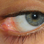 Small Wound in eye