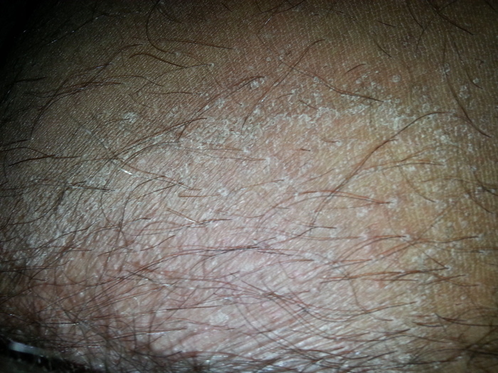 white dry skin after one year from sex