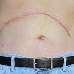 My transplant incision and hernia repair 3 months post