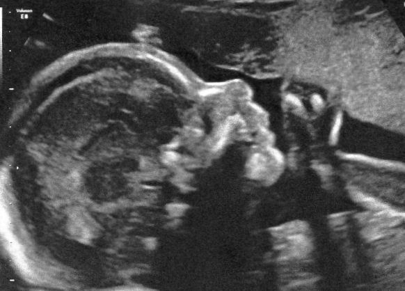 22.5 weeks scan  -  baby blue's profile