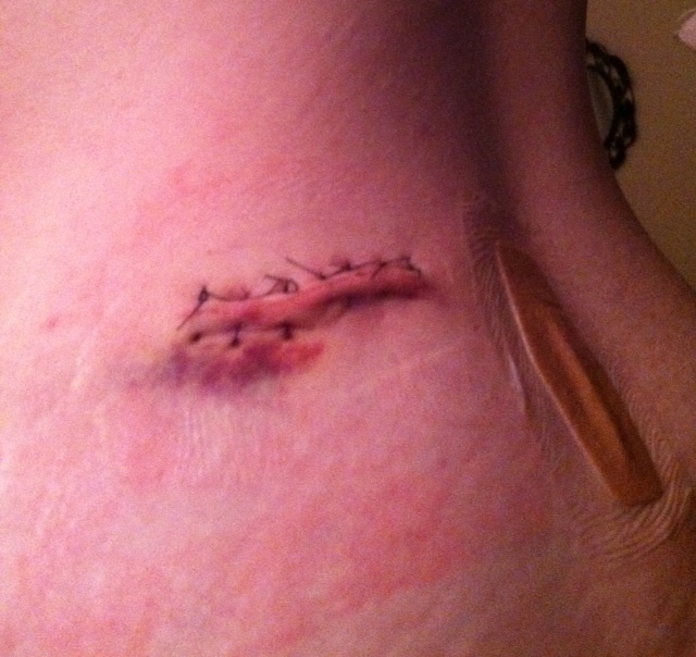I really didn't expect such long incisions.  But they should flatten out when the stitches come out