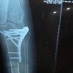 My latest leg X-Ray
