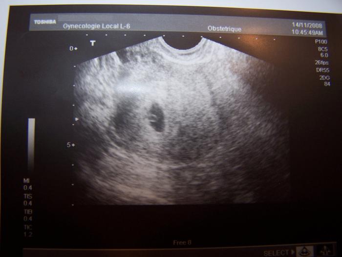 Ultrasound: 6 weeks 4 days