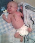 TJ as of 11/8/08 4 days after Open Heart Surgery