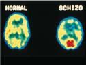 "Schizophrenic Brain" PET Scan, But How Does Mine Function After a Full Recovery From Glycine?
