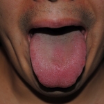 Xerostomia, April 2015. Notice the very little saliva in the tongue
