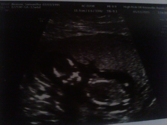 Our baby @ 13 weeks