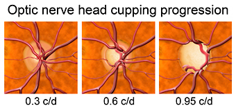 Glaucoma causes progressive damage to the optic nerve called "cupping"