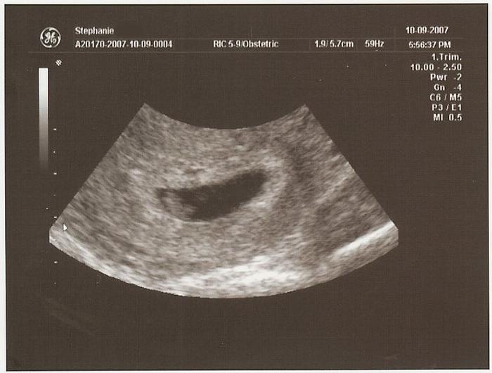 ultrasound 6 weeks