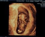 12weeks 3D ultrasound