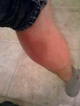 giant red rash on lower leg