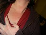 Flushing (Dysautonomia symptom)--compare blotchy redness to whiteness of hand (normal skin color)
