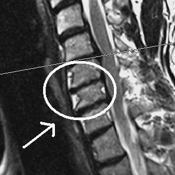 What do the "white areas" indicate on this cervical MRI?