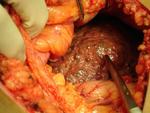 cirrhosis surgery.  You can see the damaged liver.